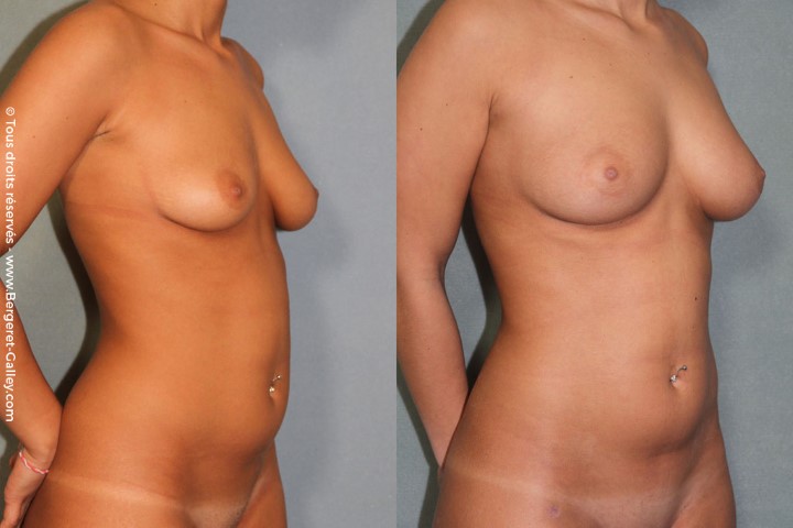 Lipofilling des seins, cas 13, photographie avant et après