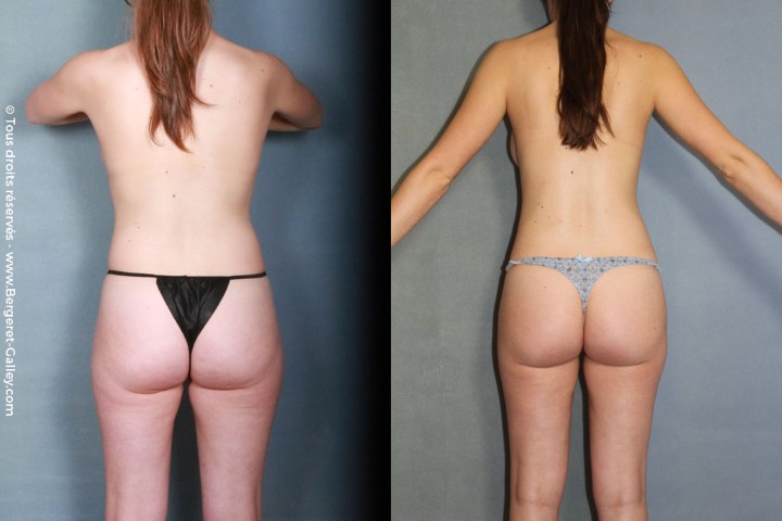 Lipofilling des seins, cas 15, photographie avant et après