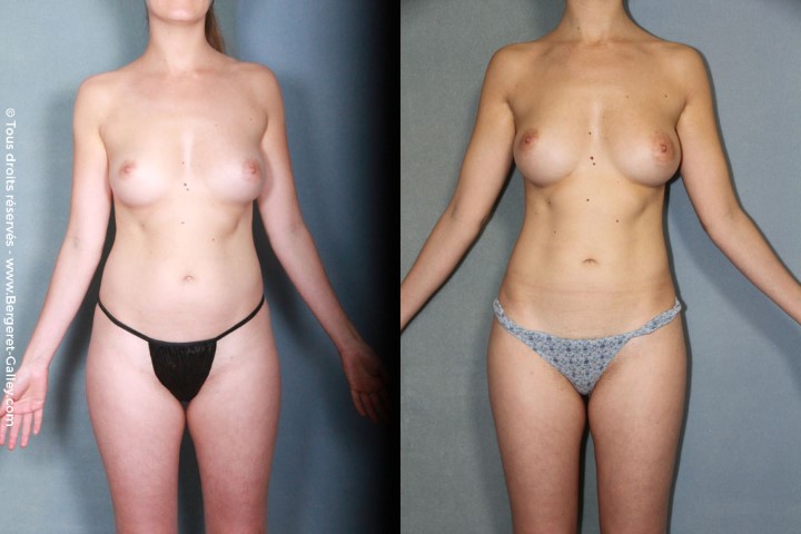 Lipofilling des seins, cas 16, photographie avant et après