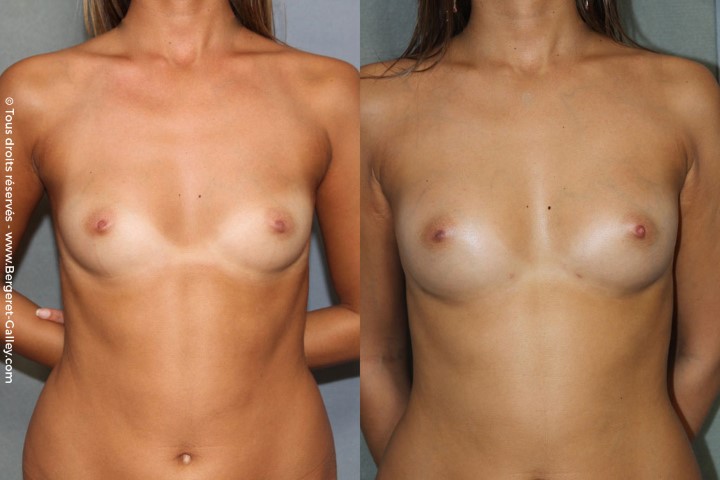 Lipofilling des seins, cas 18, photographie avant et après