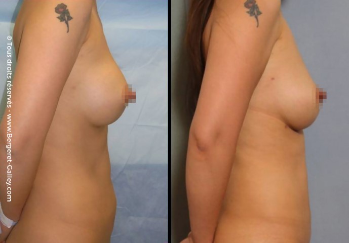 Lipofilling des seins, cas 21, photographie avant et après