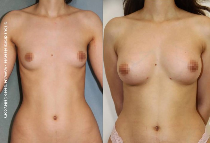 Lipofilling des seins, cas 23, photographie avant et après