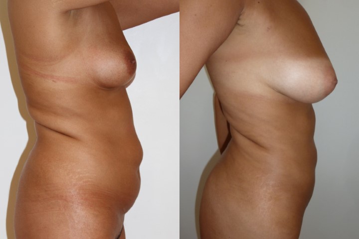 Lipofilling des seins, cas 25, photographie avant et après
