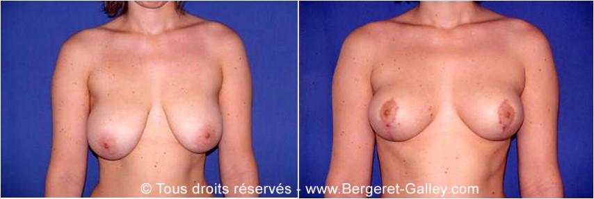 Réduction mammaire, cas 14, photographie avant et après