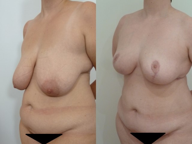 Réduction mammaire, cas 17, photographie avant et après