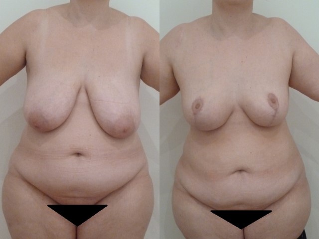 Réduction mammaire, cas 20, photographie avant et après