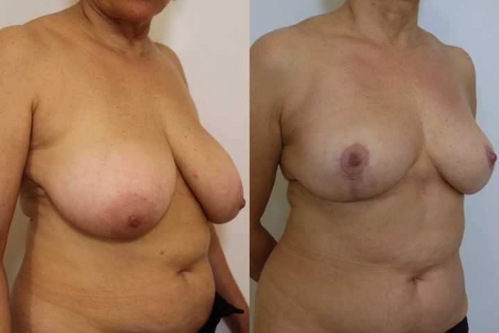 Réduction mammaire, cas 21, photographie avant et après