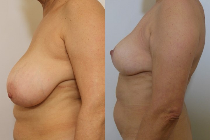 Réduction mammaire, cas 22, photographie avant et après