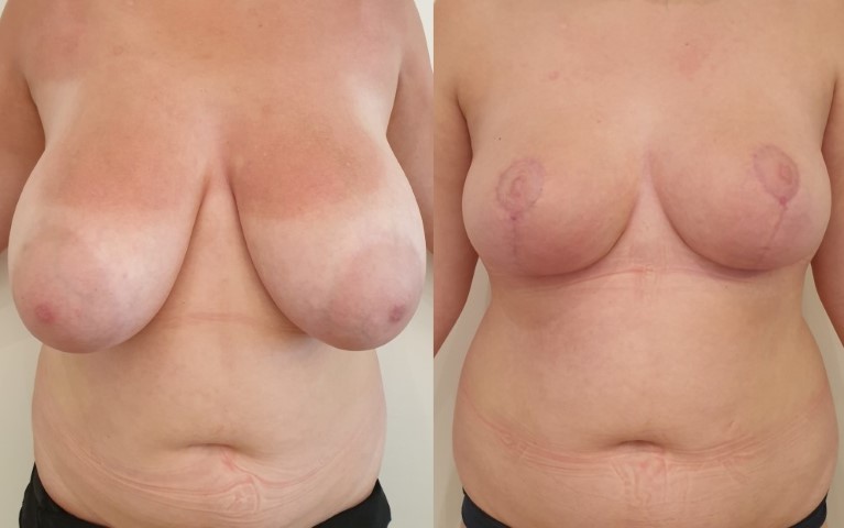 Réduction mammaire, cas 23, photographie avant et après