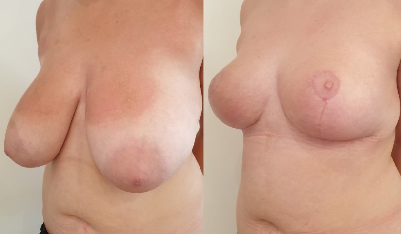 Réduction mammaire, cas 24, photographie avant et après