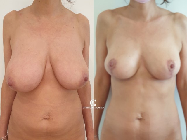 Réduction mammaire, cas 25, photographie avant et après