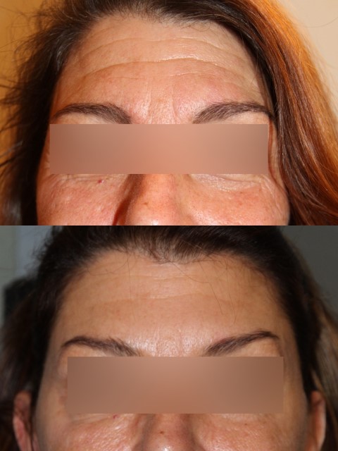 Botox du front, cas 1, photographie avant et après