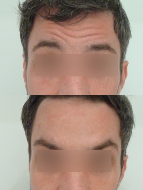 Botox du front, cas 2, photographie avant et après