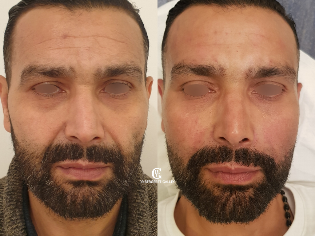 Botox du front, cas 3, photographie avant et après