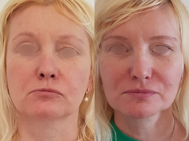 Botox du front, cas 4, photographie avant et après