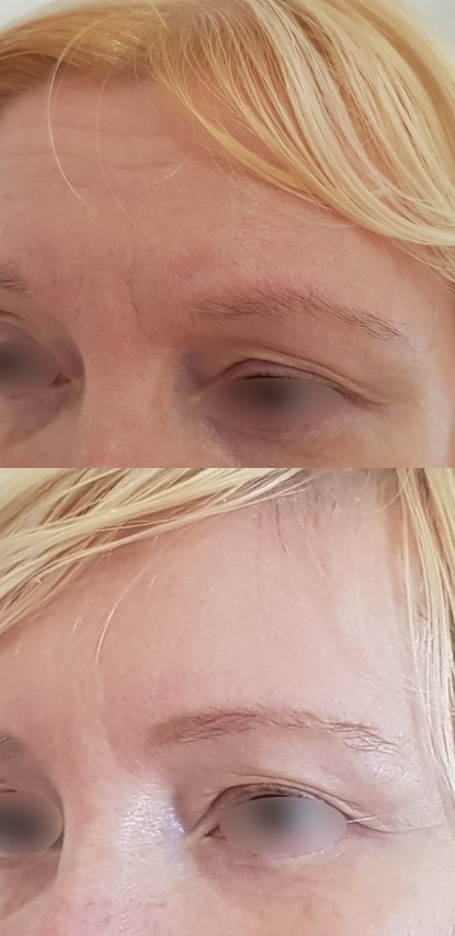 Botox du front, cas 5, photographie avant et après