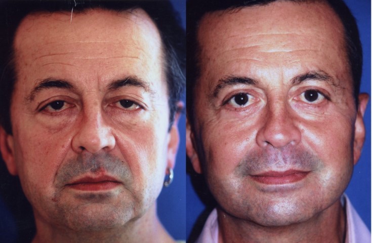 Fils tenseurs, cas 2, photographie avant et après
