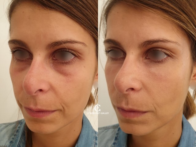 Injections, cas 7, photographie avant et après