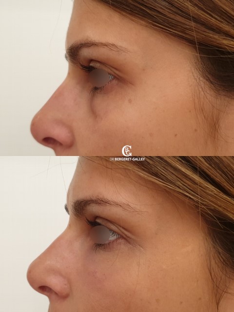 Injections, cas 8, photographie avant et après