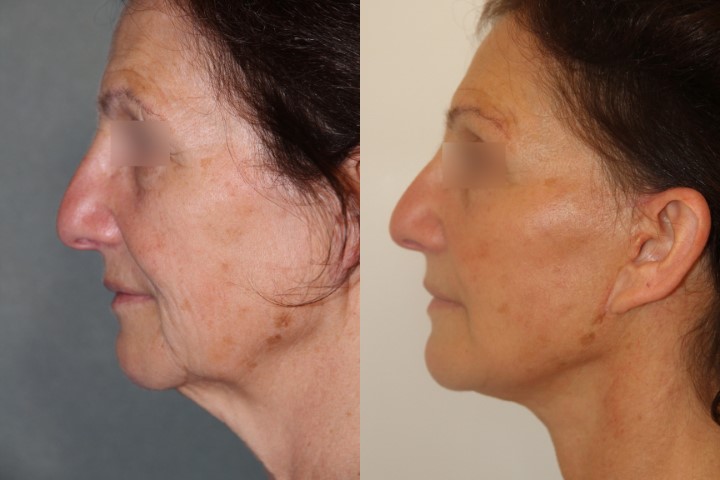 Lifting du visage, cas 1, photographie avant et après