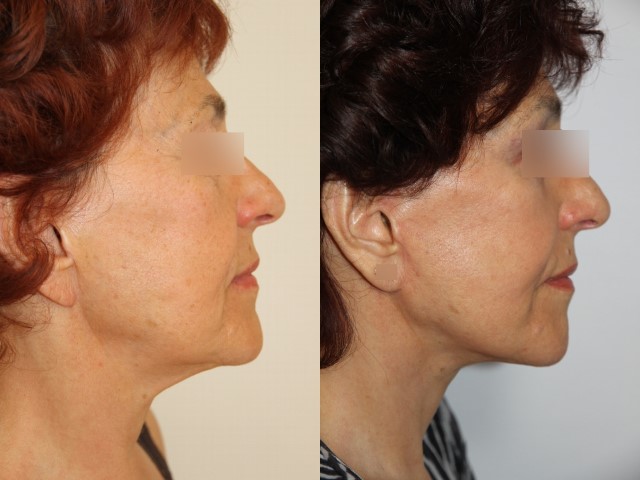 Lifting du visage, cas 2, photographie avant et après