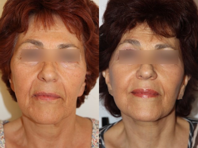 Lifting du visage, cas 3, photographie avant et après