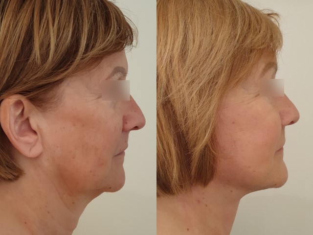 Lifting du visage, cas 4, photographie avant et après