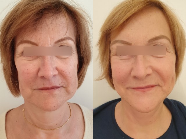 Lifting du visage, cas 5, photographie avant et après