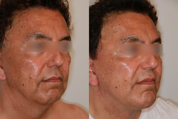 Lifting du visage, cas 6, photographie avant et après