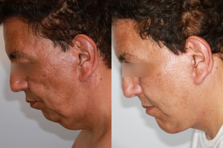 Lifting du visage, cas 7, photographie avant et après