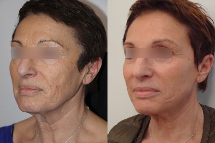 Lifting du visage, cas 10, photographie avant et après