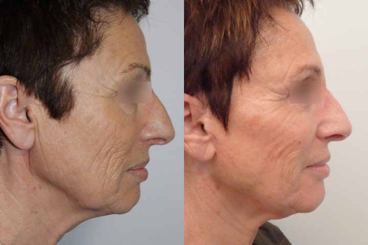 Lifting du visage, cas 11, photographie avant et après