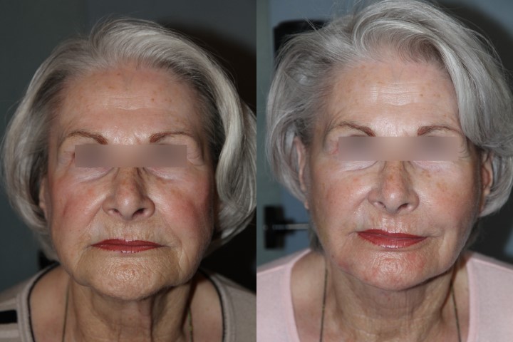 Lifting du visage, cas 12, photographie avant et après