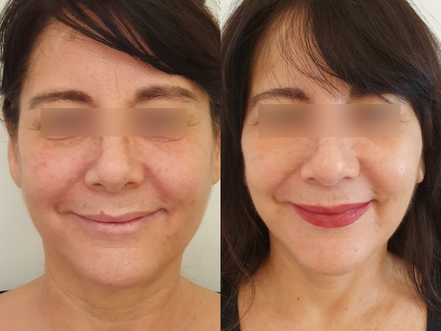 Lifting du visage, cas 13, photographie avant et après
