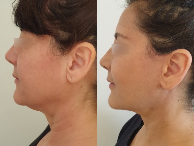 Lifting du visage, cas 14, photographie avant et après