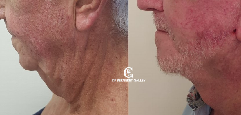 Lifting du visage, cas 16, photographie avant et après