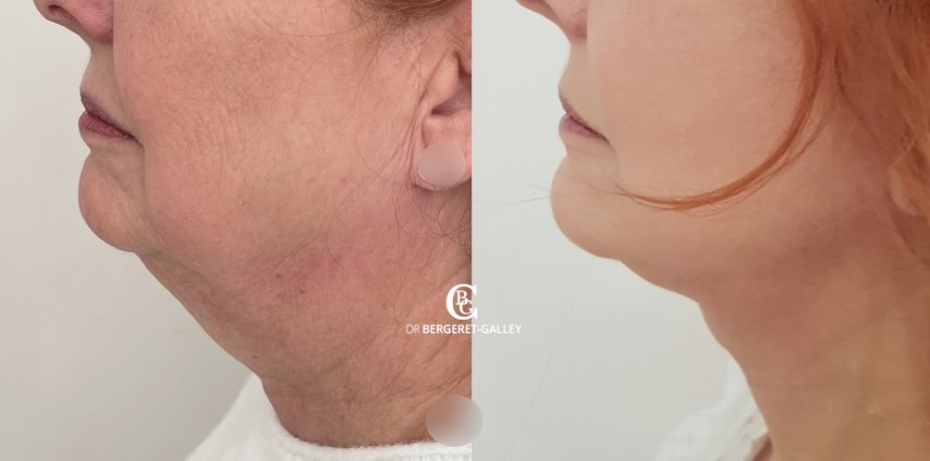 Lifting du visage, cas 17, photographie avant et après