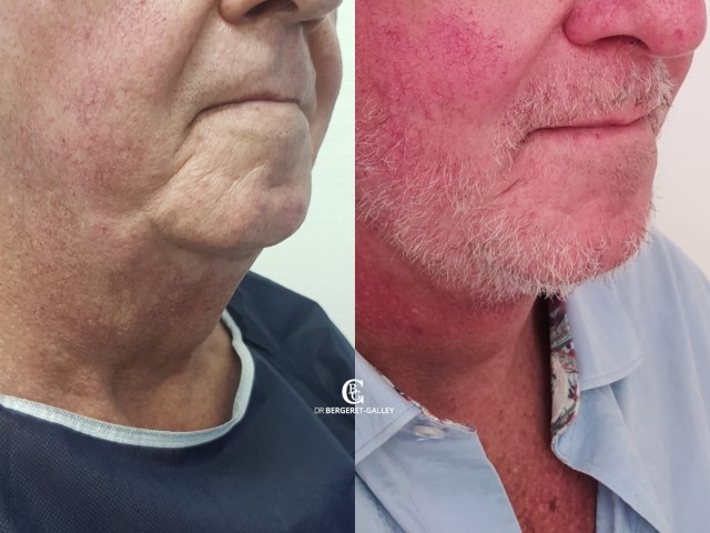 Lifting du visage, cas 18, photographie avant et après