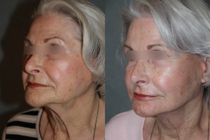 Lifting du visage, cas 19, photographie avant et après