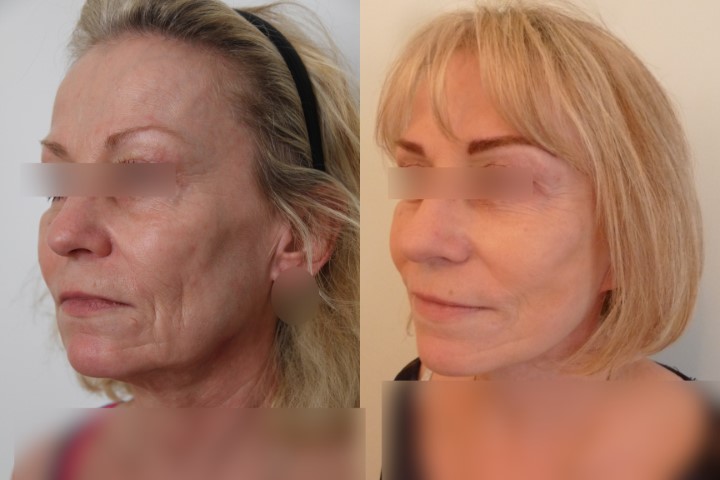 Lifting du visage, cas 21, photographie avant et après