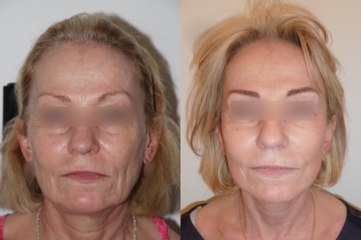 Lifting du visage, cas 22, photographie avant et après