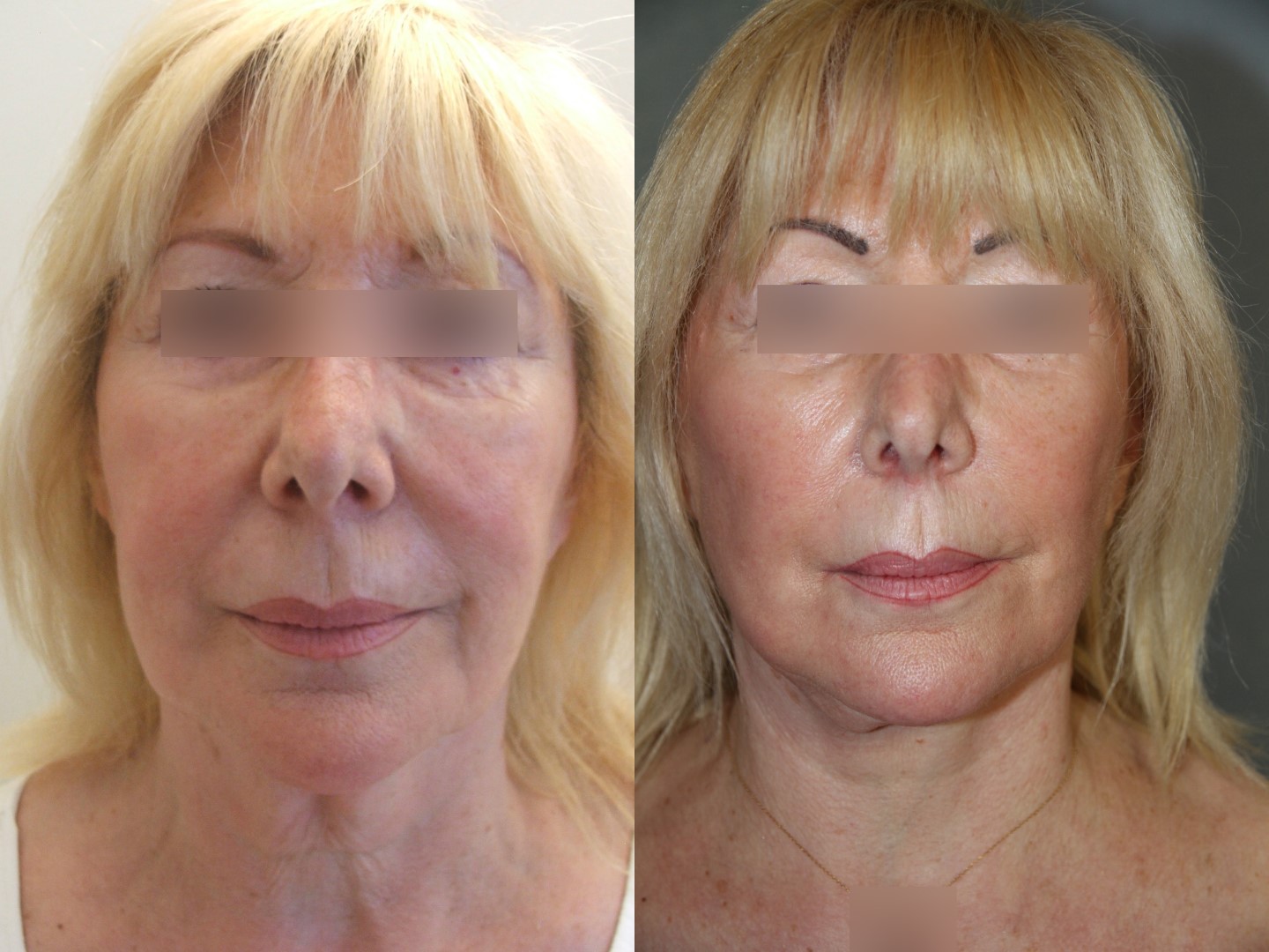 Lifting du visage, cas 23, photographie avant et après