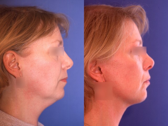 Lifting du visage, cas 25, photographie avant et après