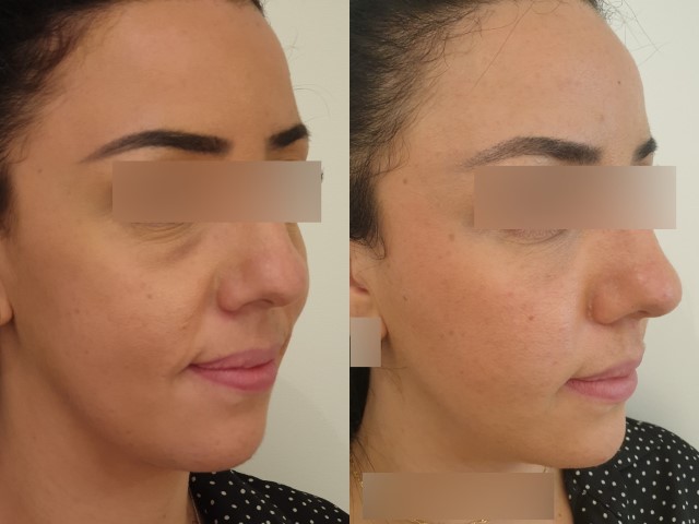 Lipofilling du visage, cas 1, photographie avant et après