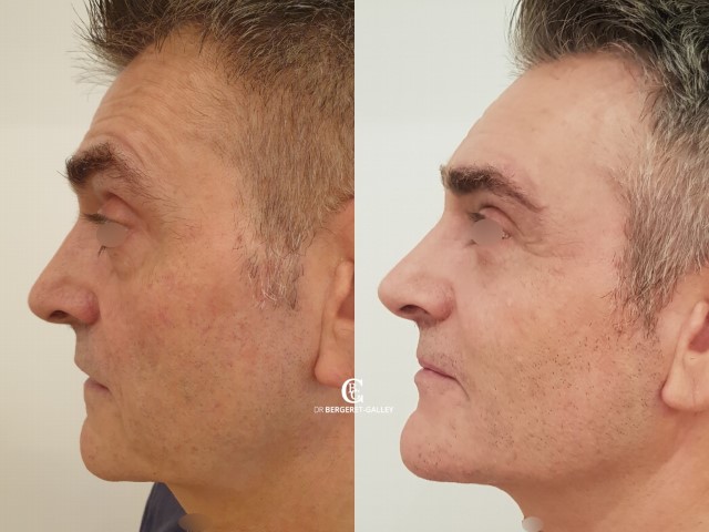 Lipofilling du visage, cas 2, photographie avant et après