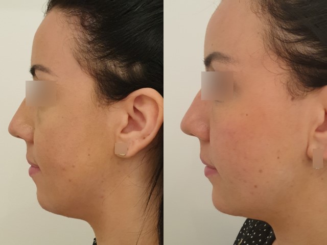 Lipofilling du visage, cas 3, photographie avant et après