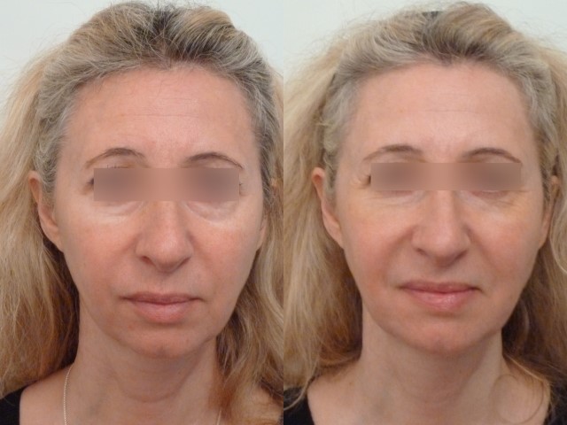 Lipofilling du visage, cas 4, photographie avant et après