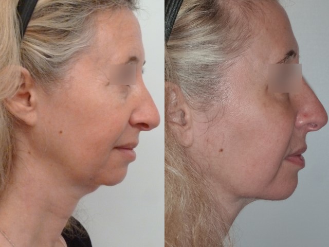 Lipofilling du visage, cas 5, photographie avant et après