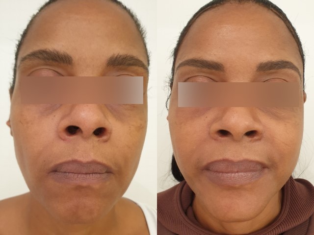 Lipofilling du visage, cas 6, photographie avant et après