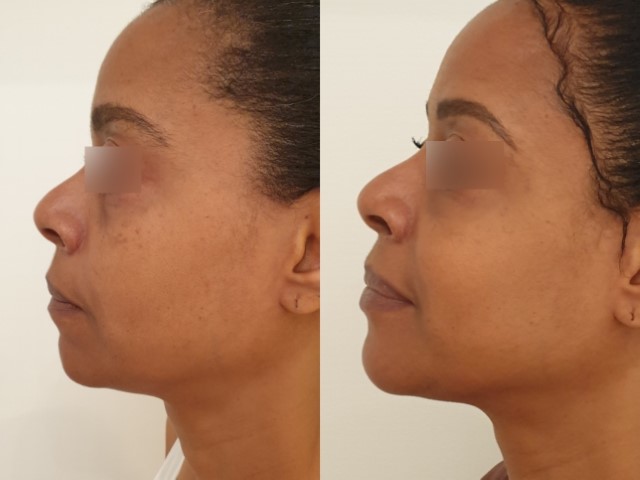 Lipofilling du visage, cas 7, photographie avant et après